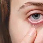 Dry Eye