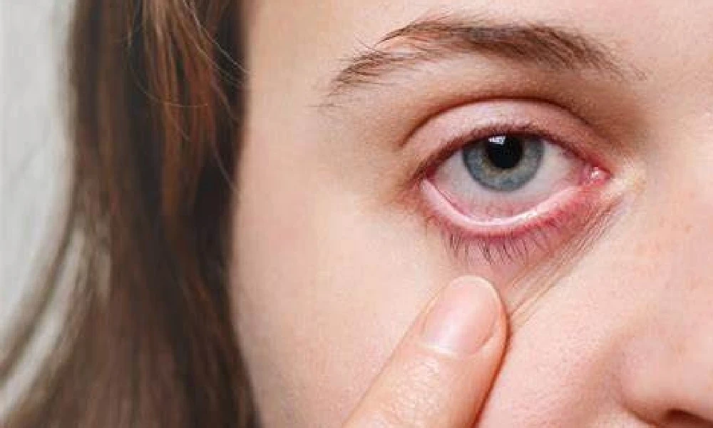 Dry Eye
