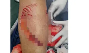 Shark Attack